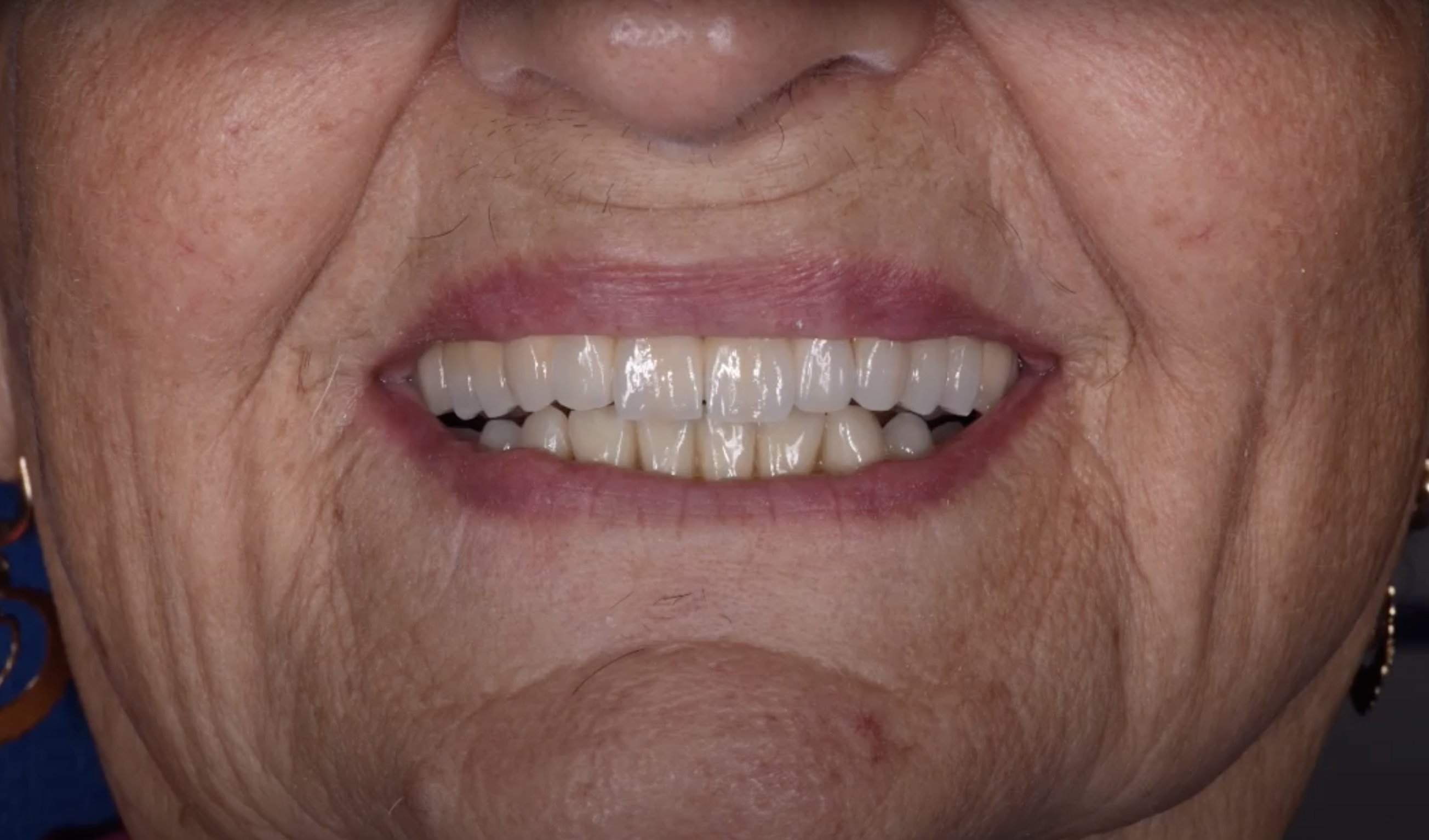 dopo operazione denti